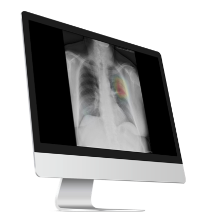 CXR Watcher displaying a chest X-ray analysis on a monitor